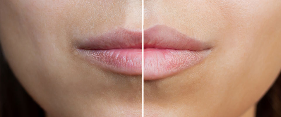 A imagem mostra a boca de uma mulher de pele clara. A imagem está dividida em duas telas. No lado esquerdo, seus lábios são mais finos, e no lado direito, seus lábios são mais volumosos e com o contorno mais marcado.