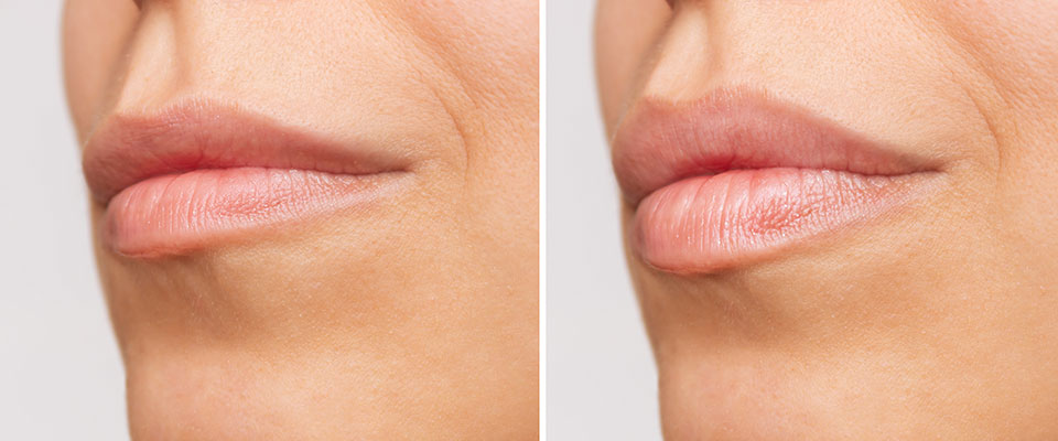 São duas imagens dos lábios de uma mulher com pele branca. Na que está mais à esquerda, os lábios são finos e pouco projetados. Na que está mais à direita, os lábios estão volumosos e mais projetados. O fundo das imagens é branco. 