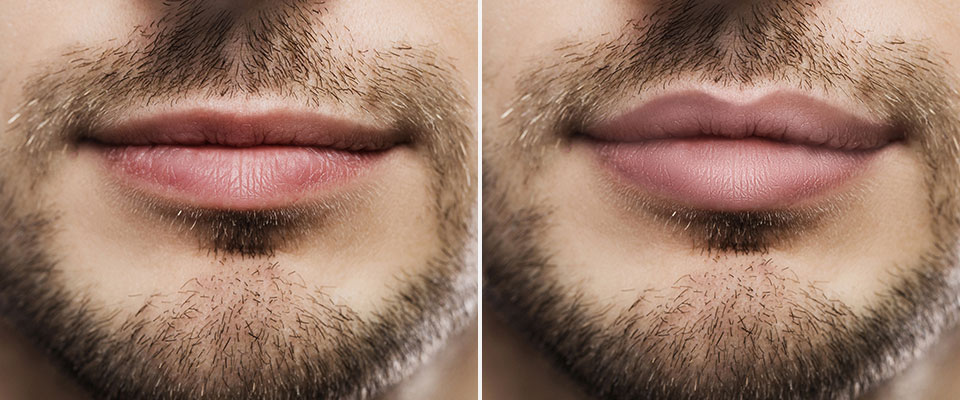 São duas imagens dos lábios de um homem com pele branca e barba castanha. Na foto que está mais à esquerda, os lábios são finos. Na que está mais à direita, os lábios estão volumosos.
