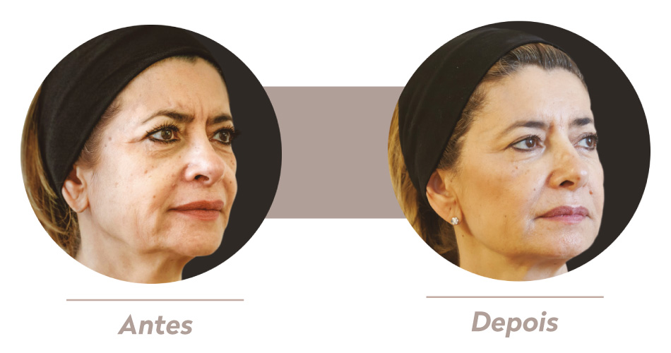 A imagem mostra duas imagens comparativas, que mostram o rosto de uma mulher branca. Na que está à esquerda, a pele da mulher apresenta mais rugas, já na à esquerda, a pele está mais lisa e homogênea. 