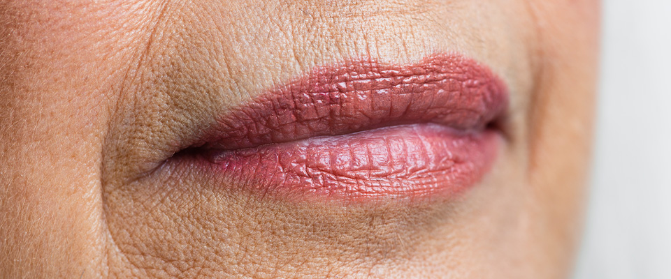 A imagem mostra a boca de uma mulher de pele clara. Sua pele ao redor da boca apresenta muitas marcas. Seus lábios estão pintados com um batom rosa pastel.